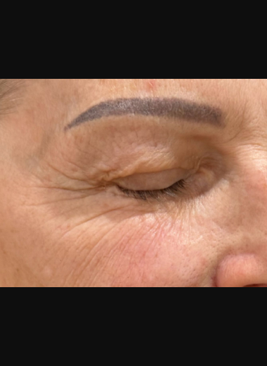 Before photo of fine lines and skin wrinkles around the eyes prior to CO2 laser skin resurfacing treatment.