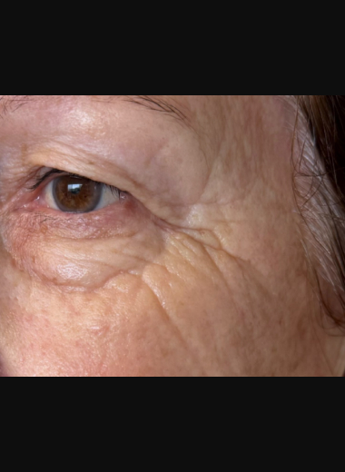 Close-up before-treatment photo of a woman's eye area showing visible fine lines, crow's feet, and skin laxity on the upper and lower eyelids prior to CO2 laser resurfacing.