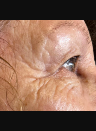 Close-up before photo of a person's eye area showing visible fine lines, crow's feet, and skin texture around the eyelid and cheek before CO2 laser treatment.