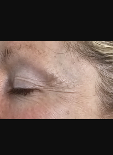 Patient case study before photo showing dynamic and static wrinkles around the lateral canthus and upper cheek area before CO2 laser treatment.