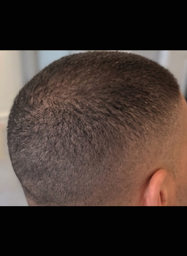 After - Hair regrowth before after 11