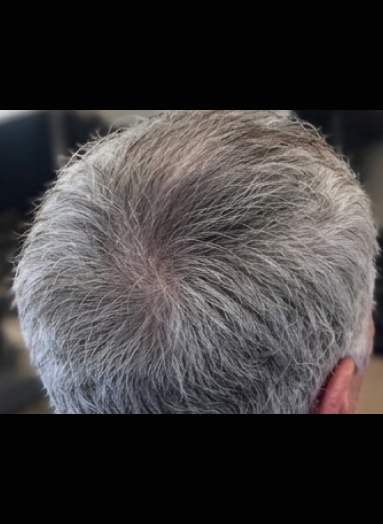 After - Hair regrowth before after 12