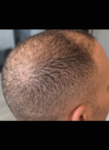 Before - Hair regrowth before after 11