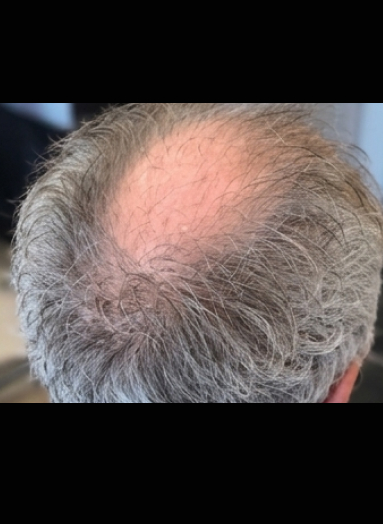 Before - Hair regrowth before after 12