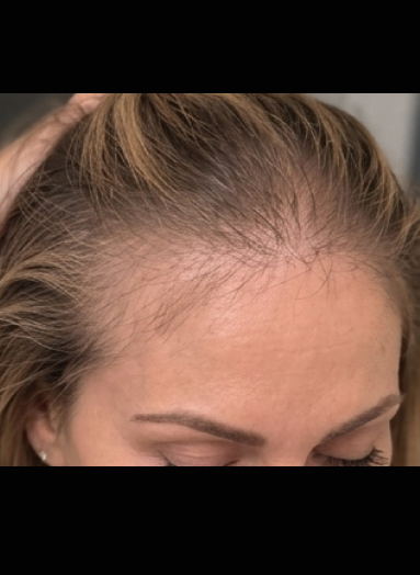 Before - Hair before after 9