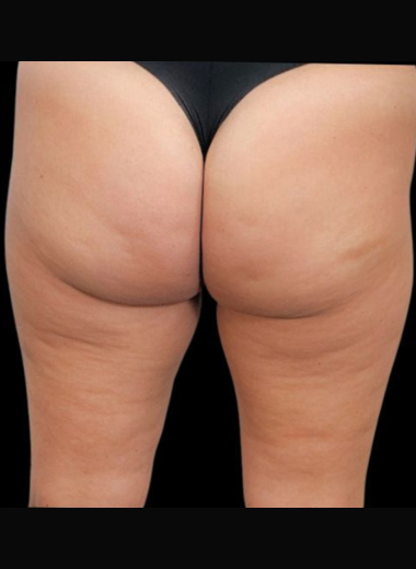 After - Cellulite before after 6
