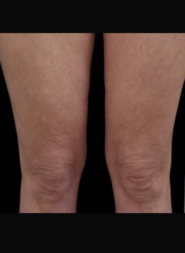 After - Cellulite before after 7