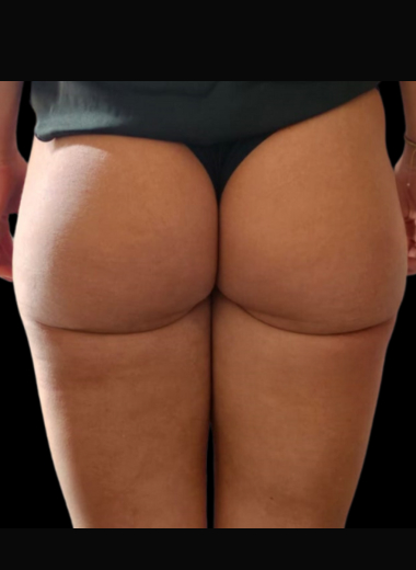 After - Cellulite before after 8