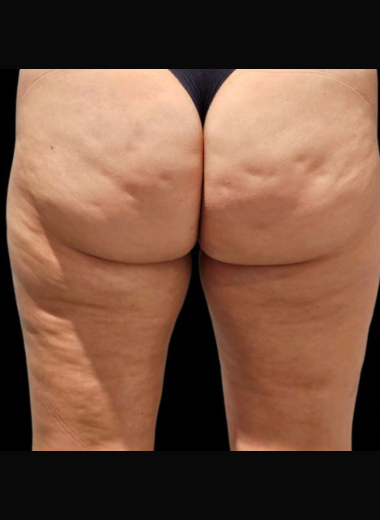 Before - Cellulite before after 6