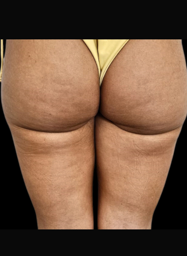 Before - Cellulite before after 8